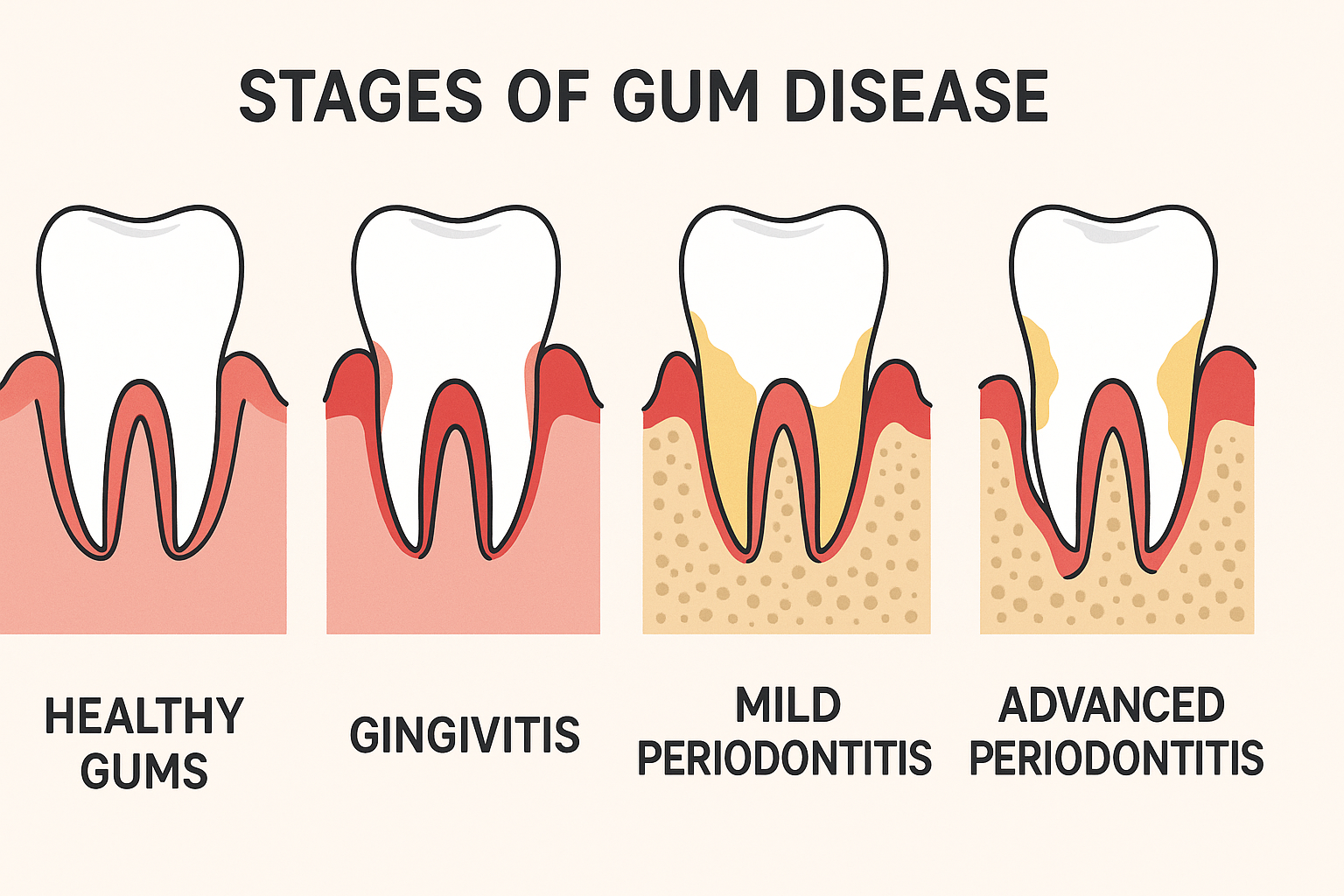 Stages of gum disease from healthy gums to periodontitis