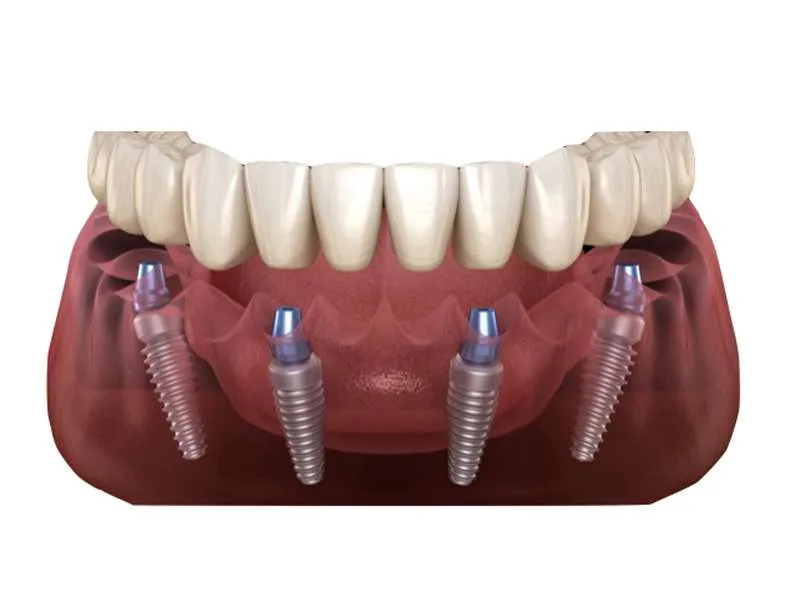 All on 4 implantes