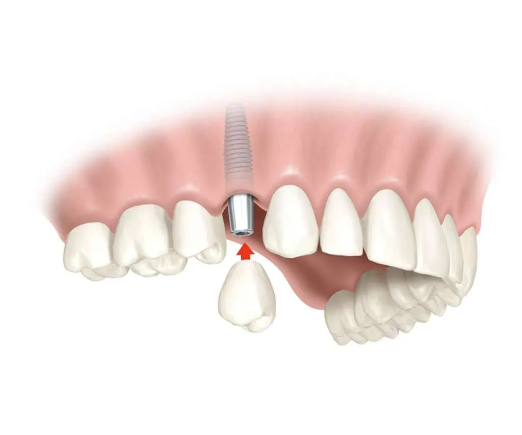 Dental Implant at Tafur Dental Clinic Gibraltar Single dental implant ilustration