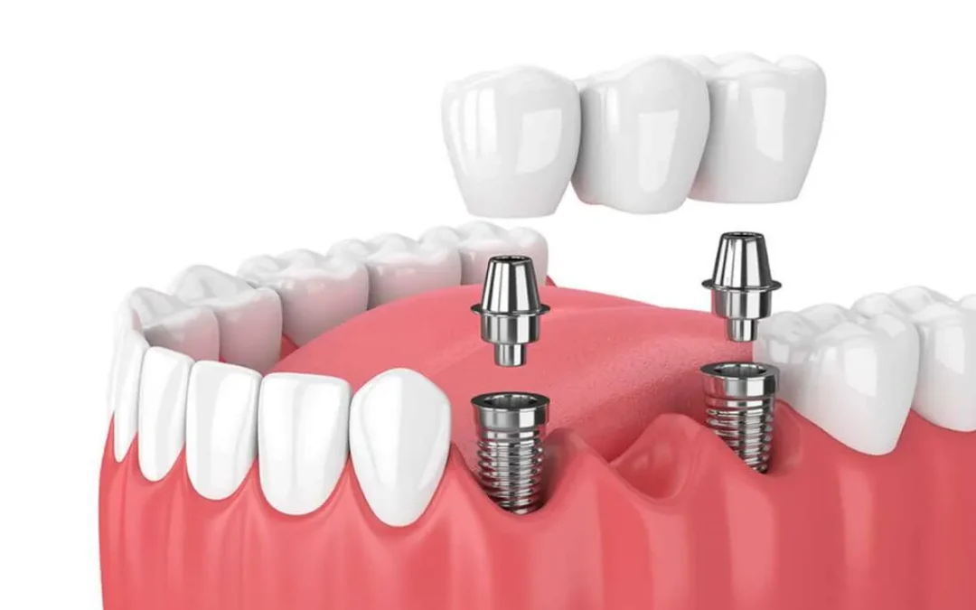 ¿Necesito un implante por cada pieza dental a reponer?
