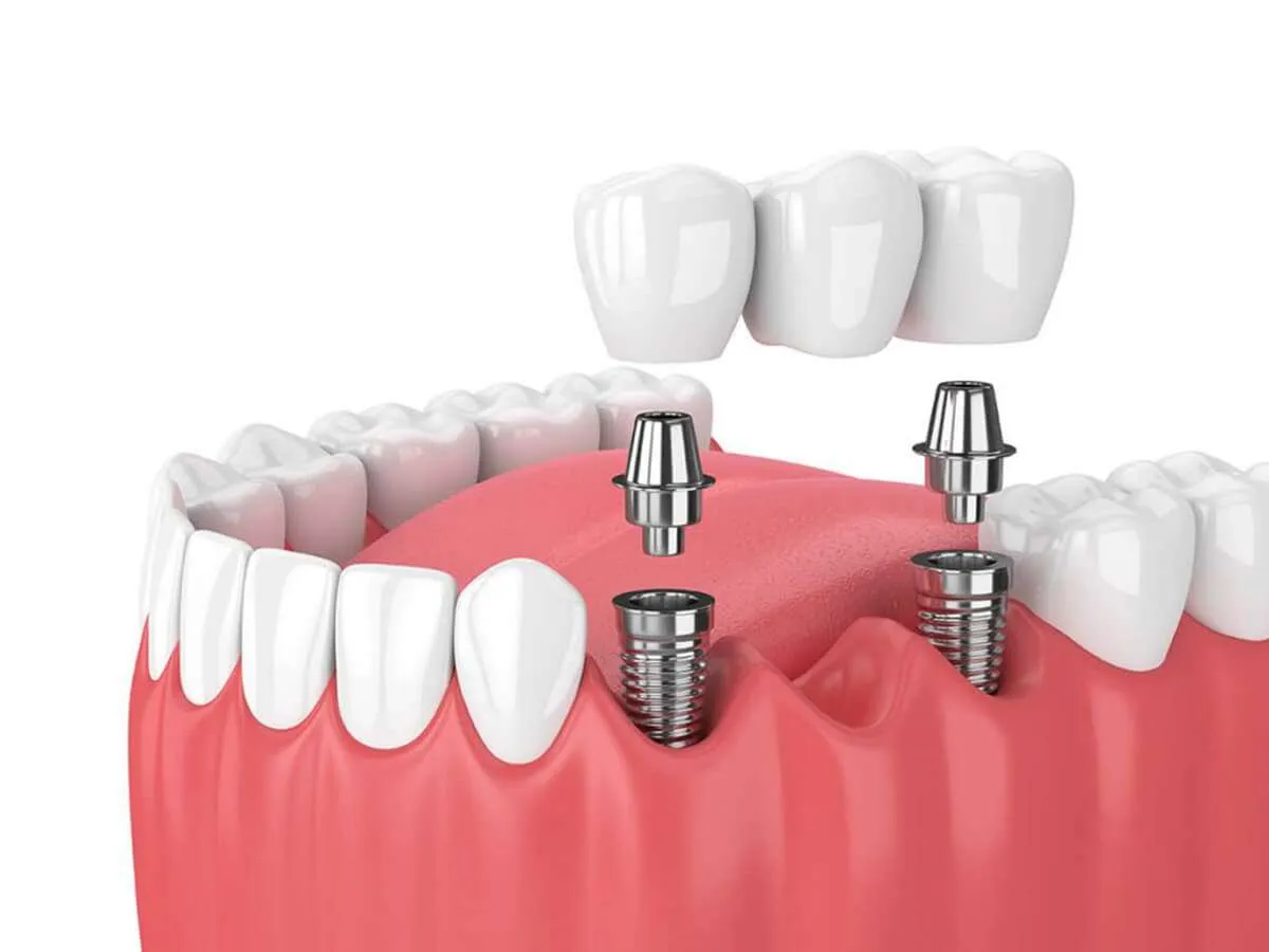implantes-dentales-zona-estetica