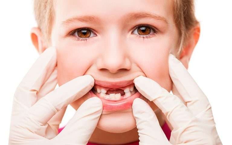 Traumatismo dental: Prevención y tratamiento en Málaga III
