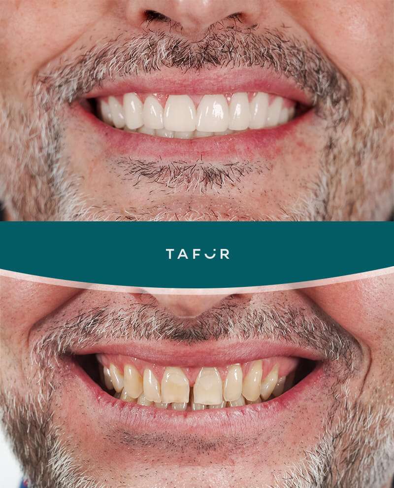 Carillas frst fit Clinica Tafur