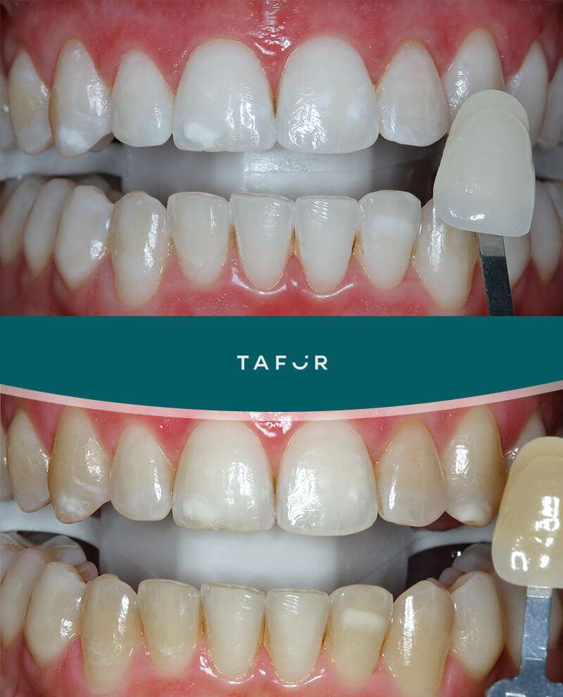 Blanqueamiento dental Clínica Tafur