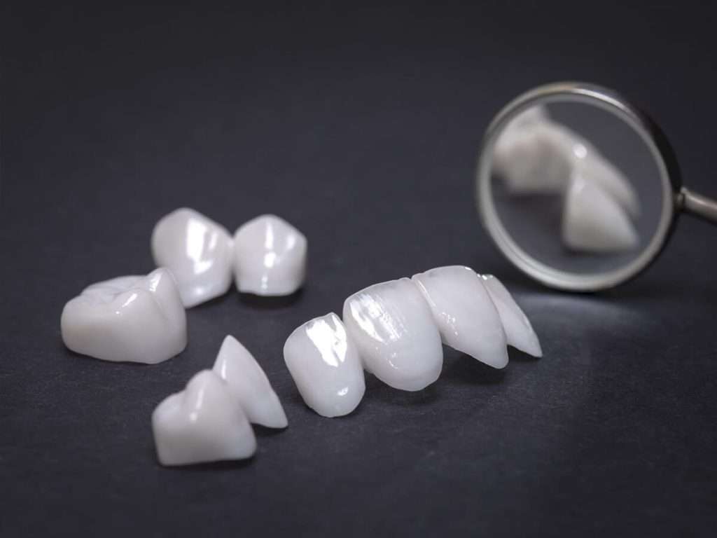Carillas dentales en Málaga