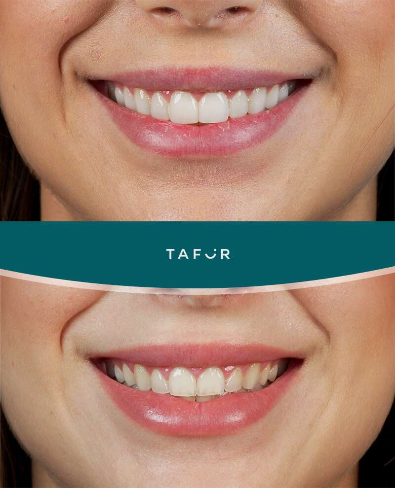 Carillas Dentales Clínica Tafur