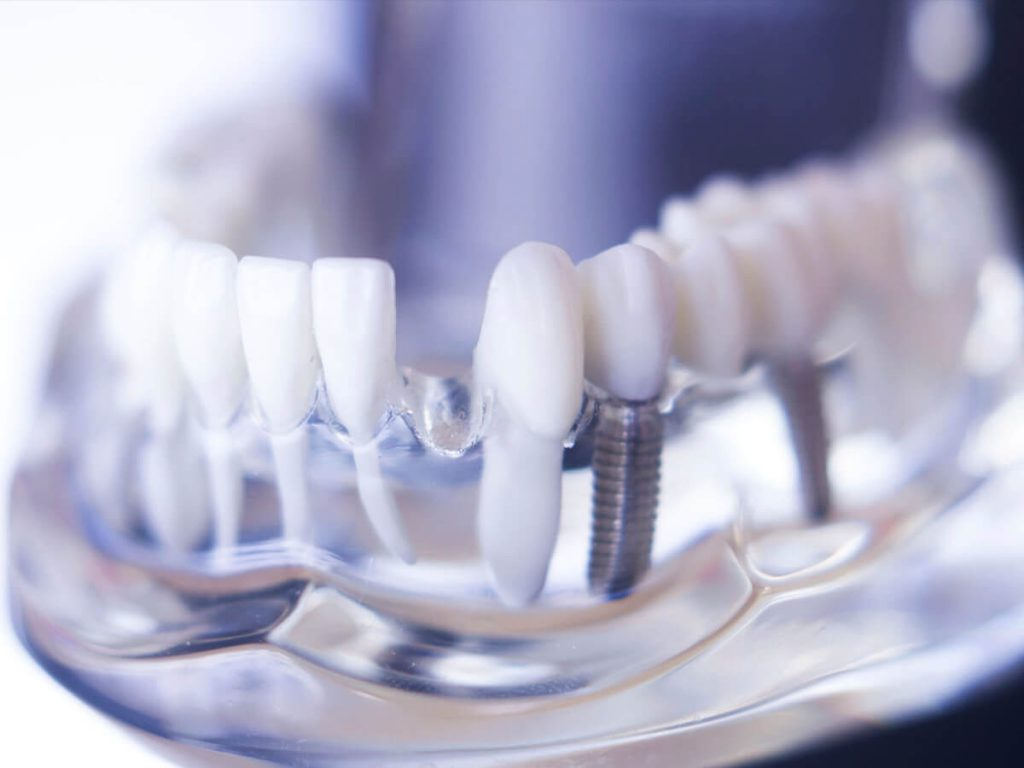 turismo dental en españa implantes dentales